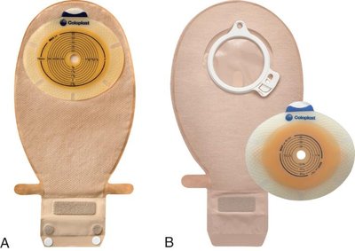 Ostomy appliance on abdomen