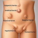 Types of abdominal hernias