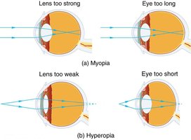 Myopia and hyperopia visual impairments