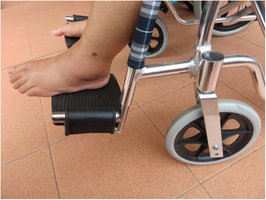 Peripheral edema in the lower leg