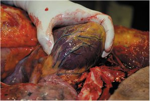 Damaged heart tissue during myocardial infarction