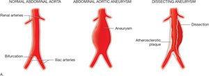 Diagram of normal and aneurysmal aorta