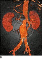 CT scan showing abdominal aortic aneurysm