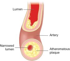 Artery narrowed by atheromatous plaque