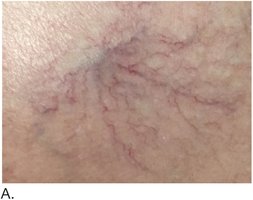 Spider veins (small varicose veins)