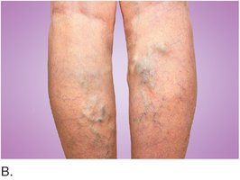 Protruding varicose veins in the legs