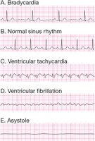 ECG tracings of different arrhythmias