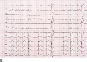 12-lead electrocardiogram
