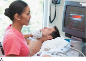 Ultrasound of carotid artery