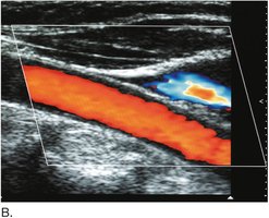 Color Doppler ultrasound image of artery