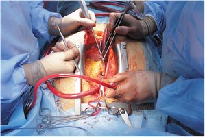 Open heart surgery procedure