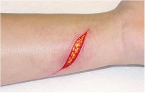 Deep laceration exposing adipose tissue