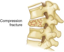Compression fracture