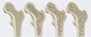 Normal bone vs. osteoporosis