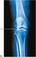 Normal knee joint x-ray