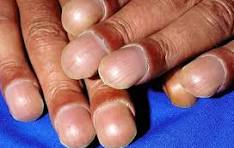 Clubbing of fingers due to hypoxia