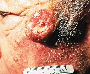 Basal cell carcinoma on the face