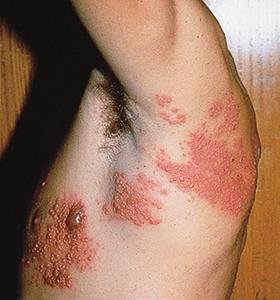 Herpes zoster (shingles) rash along the side of the torso