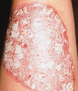 Psoriasis with silvery-white scales on red plaques