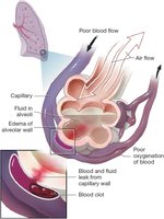 Diagram of ARDS with fluid-filled alveolus