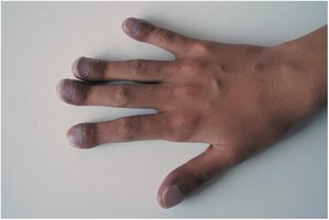 Hand showing cyanosis and clubbing
