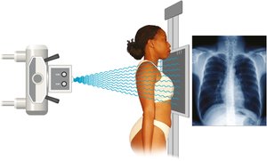 Patient having a PA chest x-ray