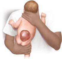 Illustration of a child born with spina bifida, with a large meningocele.