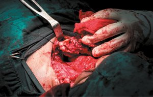 Thyroidectomy surgery showing removal of the thyroid gland.