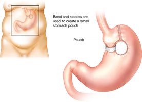Gastroplasty: surgical repair of the stomach with band and staples to create a small pouch.