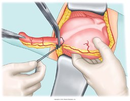 Appendectomy procedure