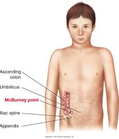 Appendicitis and McBurney point