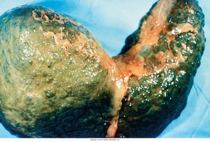 Cirrhosis of the liver