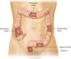 Common sites of colorectal cancer