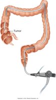 Visualization of a tumor with a colonoscope