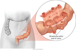 Diverticulitis and diverticula within the colon wall