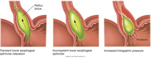 Mechanisms of gastroesophageal reflux
