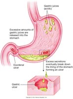 Peptic ulcer disease