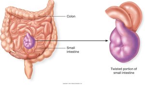 Volvulus (twisting of the intestine)