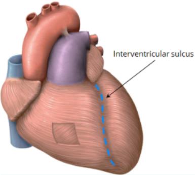 Interventricular sulcus in cadaveric heart