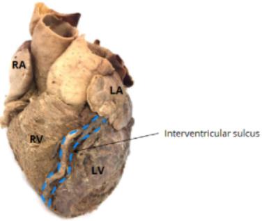 Interventricular septum