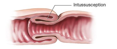 Intussusception of the intestine