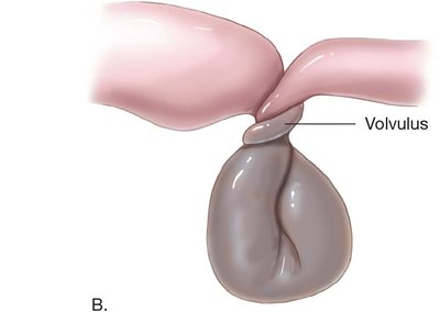 Volvulus of the intestine