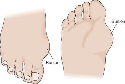 Bunion at the base of the great toe