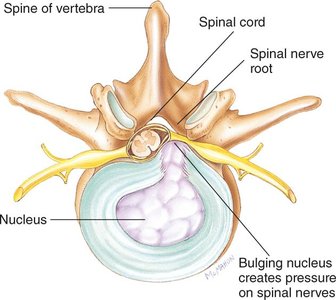 Herniated disk compressing spinal nerves