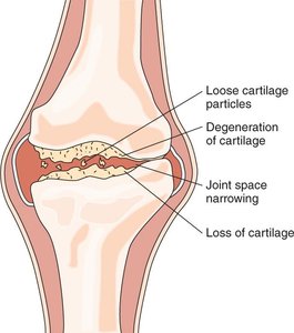 Osteoarthritis with cartilage degeneration