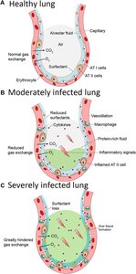 Healthy vs infected alveoli