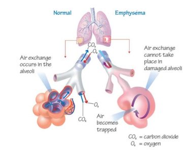 Normal vs emphysema air exchange