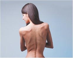 Muscle atrophy