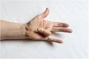 Dupuytren contracture
