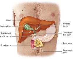 Gallstones in the biliary and pancreatic ducts